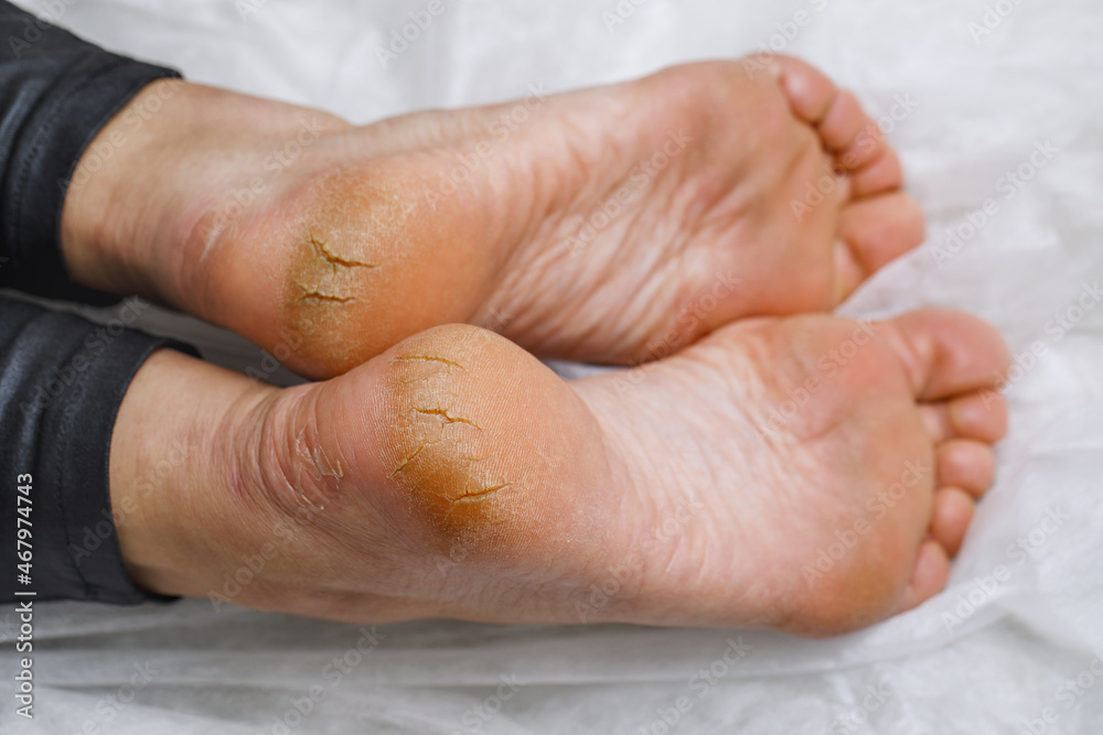 Cracked heels in a woman. Medical pedicure in the salon. Problematic sore foot with dry skin. Photo of legs before processing by the master. Cracked heels in a woman. Medical pedicure in the salon. Problematic sore foot with dry skin. Photo of legs before processing by the master.