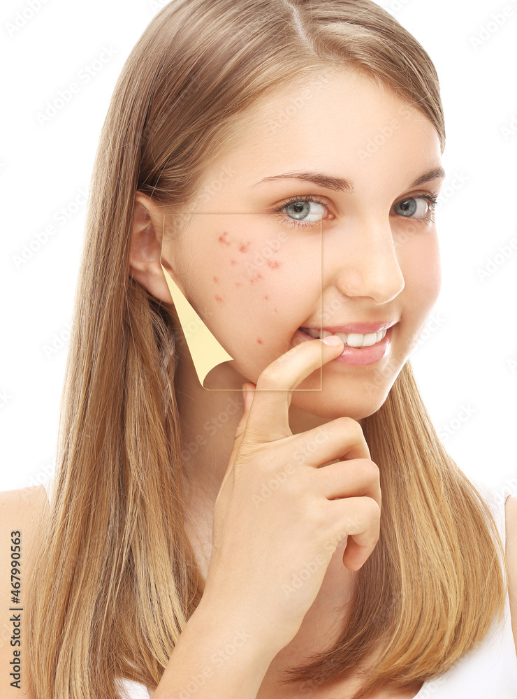 Post-Acne Marks /Treating Acne Scars.Acne Scar Removal. Post-Acne Marks /Treating Acne Scars.Acne Scar Removal.