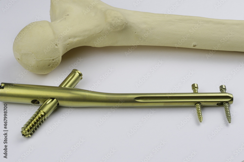 Gamma nail in case of treatment of proximal hip fracture StockFoto