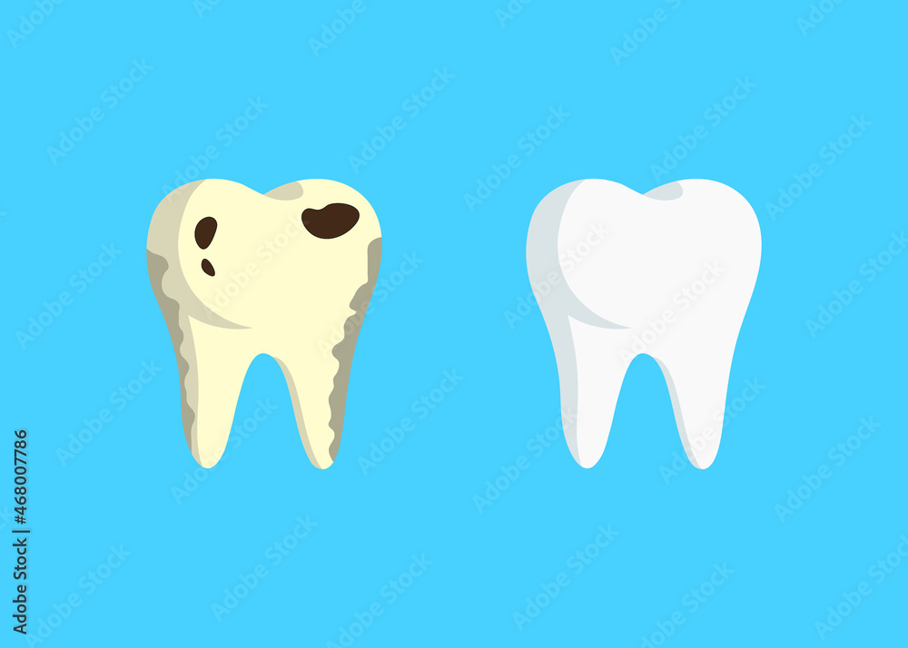flat style illustration of healthy white tooth and yellow tooth with caries on a blue background. concept of comparing teeth, caries treatment before after flat style illustration of healthy white tooth and yellow tooth with caries on a blue background. concept of comparing teeth, caries treatment before after