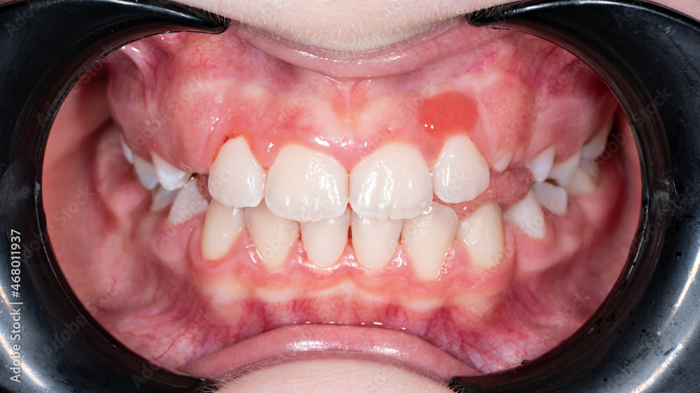 Capillary hemangioma of the gingival mucosa in a child. Epulis on the gum close-up.