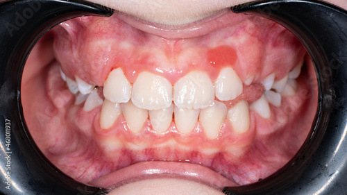 Capillary hemangioma of the gingival mucosa in a child. Epulis on the gum close-up. photo