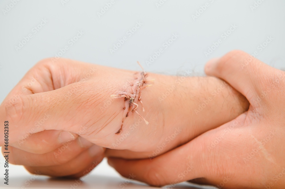 Suture wound on hand,Pain of accident concept