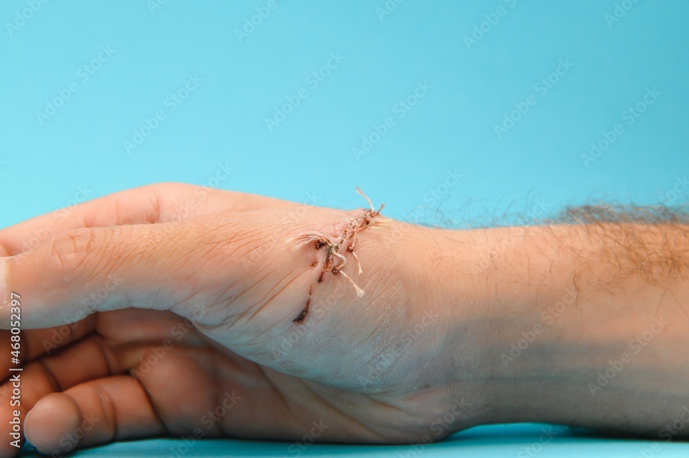 Suture wound on hand from dermatology procedure Suture wound on hand from dermatology procedure