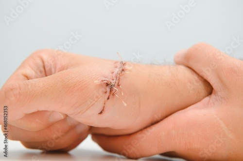 Suture wound on hand,Pain of accident concept