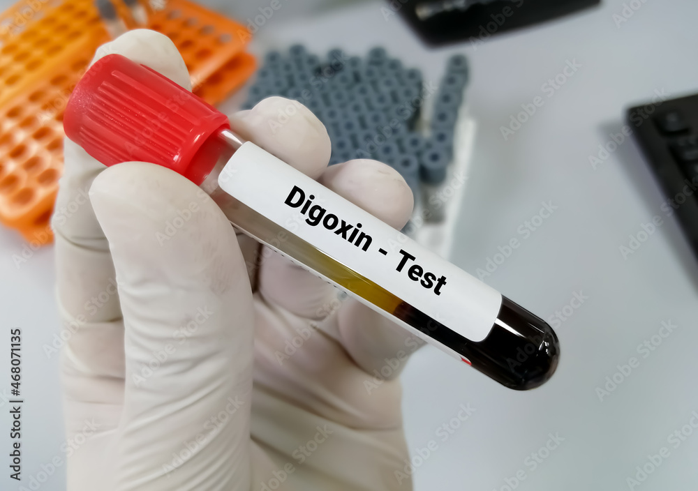 Blood sample for Digoxin level test, drug for heart disease.