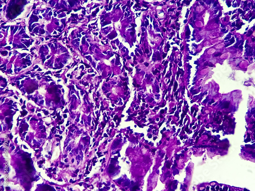 Squamous cell carcinoma of a human, photomicrograph panorama as seen under the microscope, 200x zoom. photo