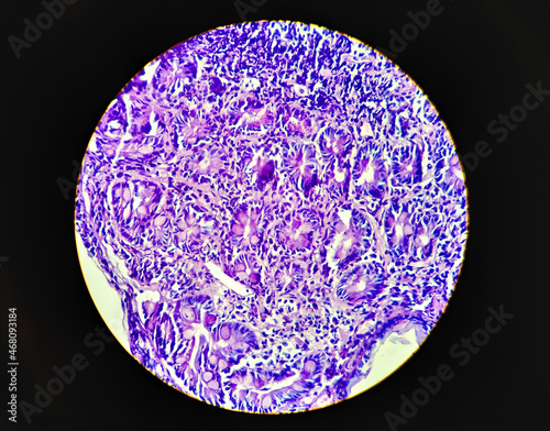 Squamous cell carcinoma of a human, photomicrograph panorama as seen under the microscope, 200x zoom. photo