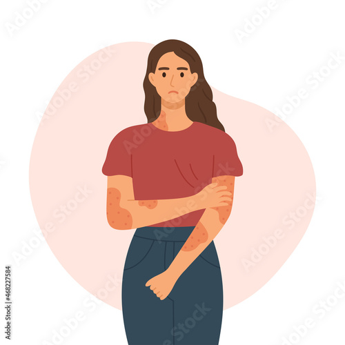 Woman with skin disease concept. Skin rash, psoriasis, dermatitis or eczema flat style vector illustration.