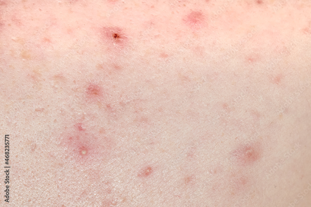 Human skin with acne close up. Acne scars.
