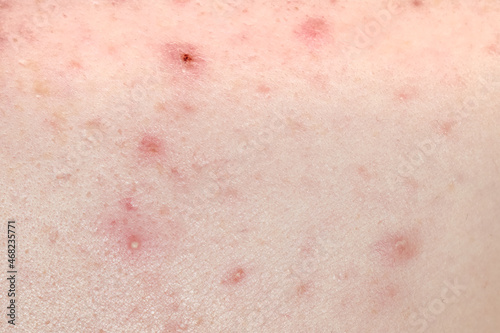 Human skin with acne close up. Acne scars.