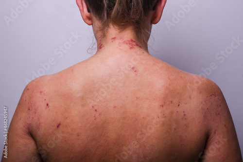 atopic dermatitis in a strong stage on the back of a girl.  bloody painful wounds from scratching.  skin diseases.  dermatology