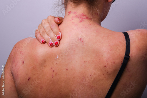 severe exacerbation of atopic dermatitis. Girl applying moisturizer to her skin