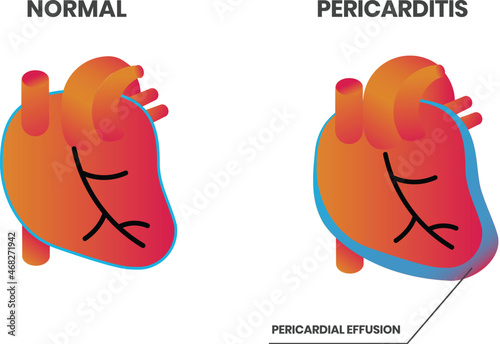 Normal heart anatomy vs pericarditis vector illustration