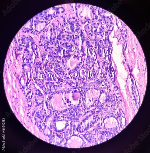Microphotograph(microscopic image) of Nodular goitre with adenomatous change in thyroid tissue, 40x view