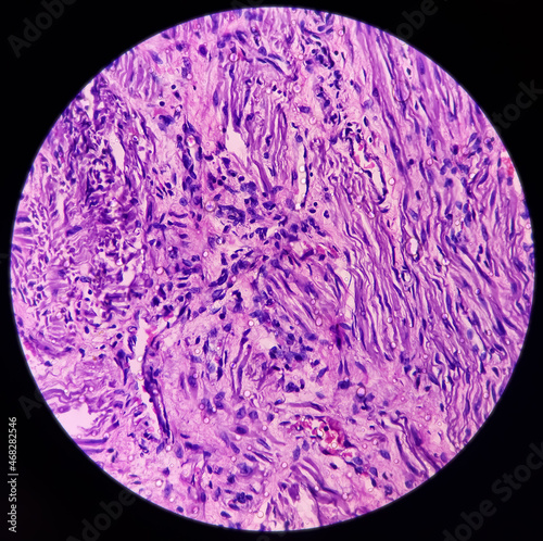 Microscopic image of chronic epididymo-orchitis in testis tissues, showing testicular tissue and epididymis, acute and chronic inflammatory cells and peritubular fibrosis present photo