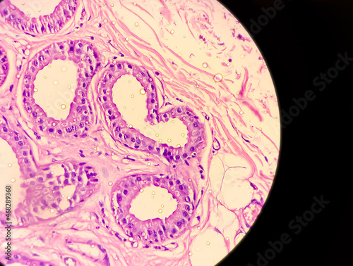 Foto Microscopic image of Hidradenitis suppurativa in axillary mass tissues