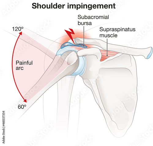 Obraz na płótnie Shoulder impingement