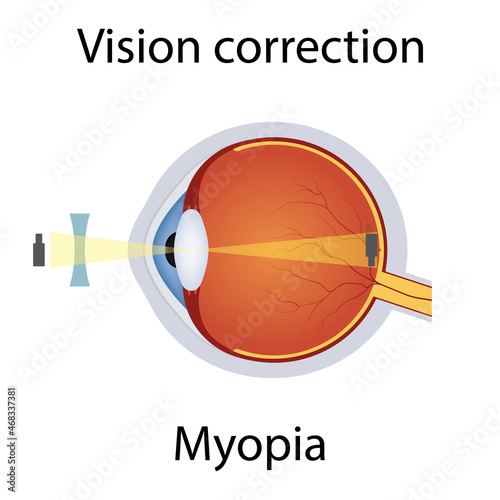 Vision Correction of Myopia Illustration. Eyesight Disorders. Eyes Defect Corrected by Concave Lens Concept. Detailed Anatomy Eyeball with Myopia Defect. Isolated Vector