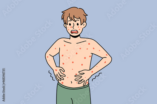 Unhealthy boy with red spots on body suffer from measles or rubella. Anxious unwell man struggle with rash fever, have severe symptoms. Healthcare concept. Flat vector illustration. 