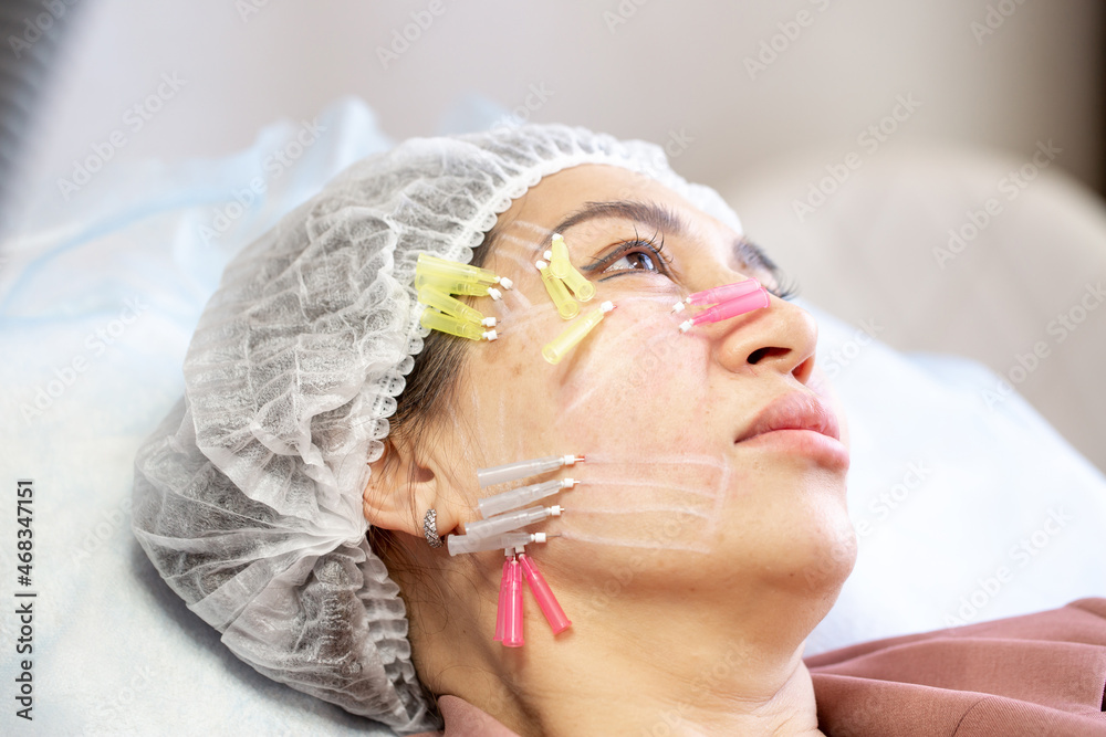 Thread lifting is a cosmetological procedure for face rejuvenation. The