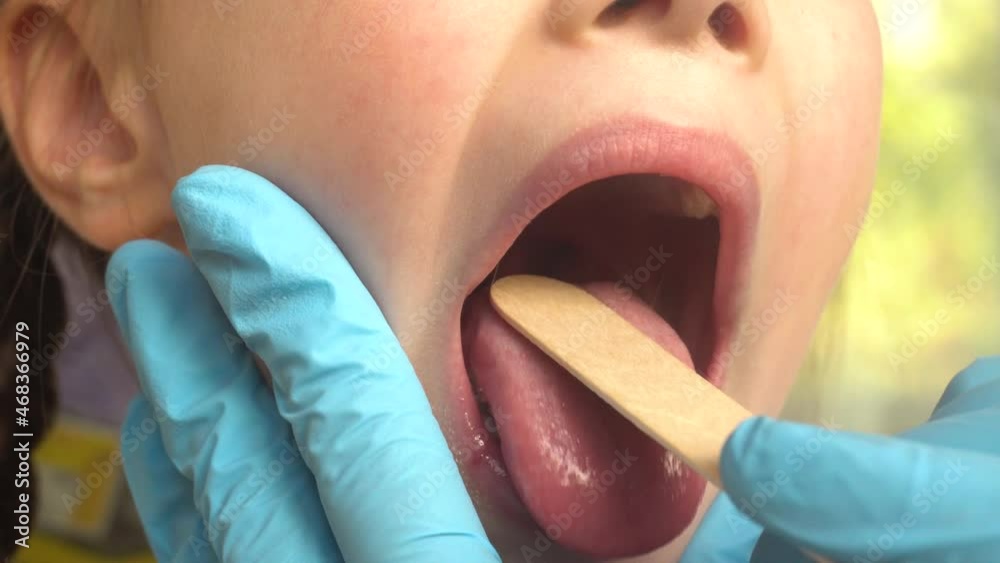 Close-up of a doctor examining a child's mouth and throat using a tongue depressor.ENT medicine.