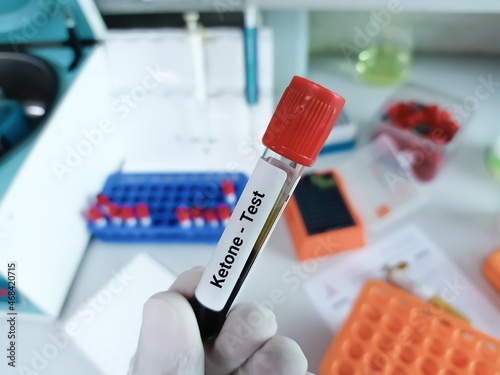 Doctor holds blood sample for Ketone test. Medical test tube in laboratory background.