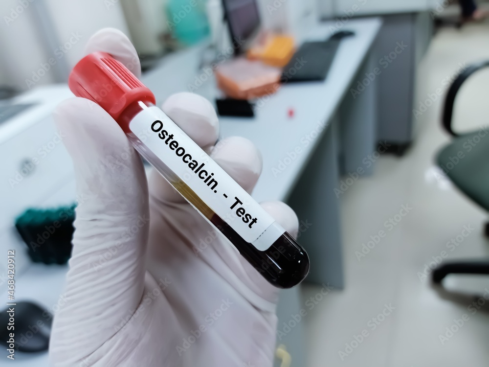 Blood sample for osteocalcin test. bone marker. Medical test tube in laboratory background.