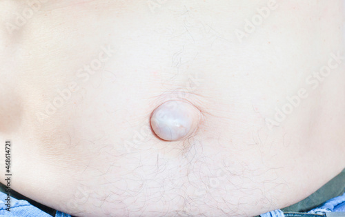 Obraz na plátně Person organ of the navel are abnormal, the skin surface of the abdomen