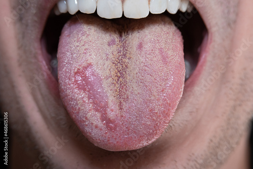 Caucasian male tongue with yeast infection candida. Macro close up shot, unrecognizable photo