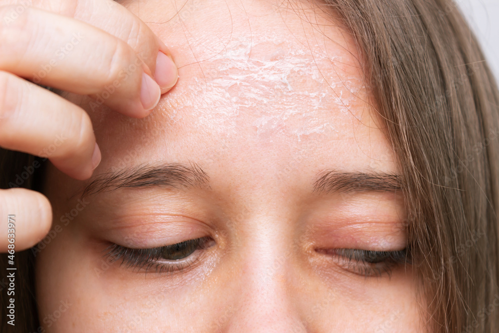Как выглядит сухая кожа лица Close-up of a female forehead with peeling skin isolated on a white background. 