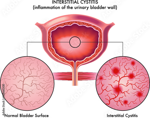 Medical illustration of the symptoms of interstitial cystitis.