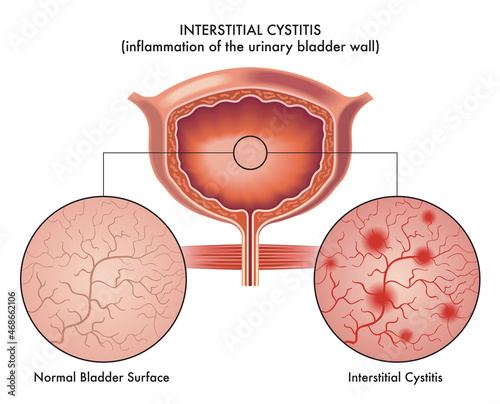 Medical illustration of the symptoms of interstitial cystitis.