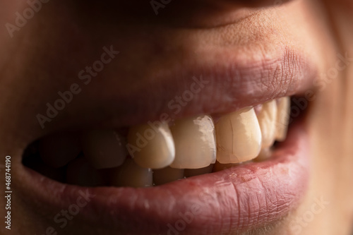 Close up photo of a woman with the cracked teeth. Teeth care concept. Selective focus.