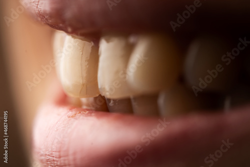 Close up photo of a woman with the cracked teeth. Teeth care concept. Selective focus.