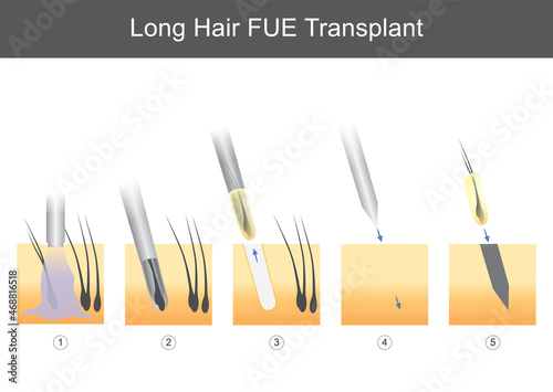 Long Hair FUE Transplant. Illustration for medical showing technical steps of hair transplantation.. photo