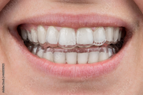 Close-up of a caucasian woman smiling with aligners on her teeth. Macro.