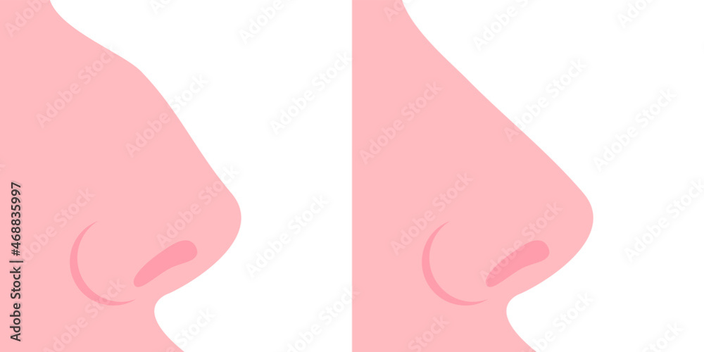 The nose is crooked and the nose is straight. Concept: rhinoplasty, before and after surgery. Vector illustration, flat cartoon color minimal design isolated on white background, eps 10.