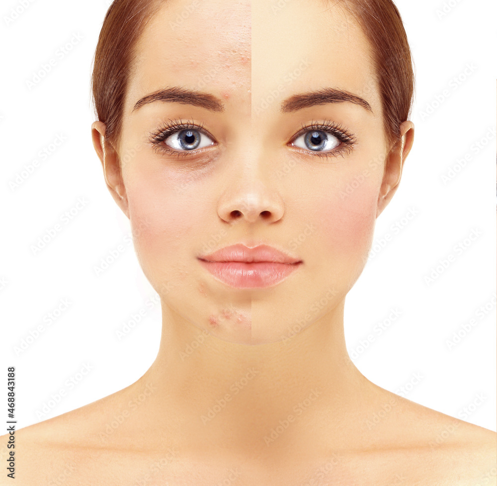 Post-Acne Marks /Treating Acne Scars Post-Acne Marks /Treating Acne Scars