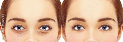 Lower eyelid blepharoplasty.Upper  blepharoplasty.Before and after cosmetic procedures