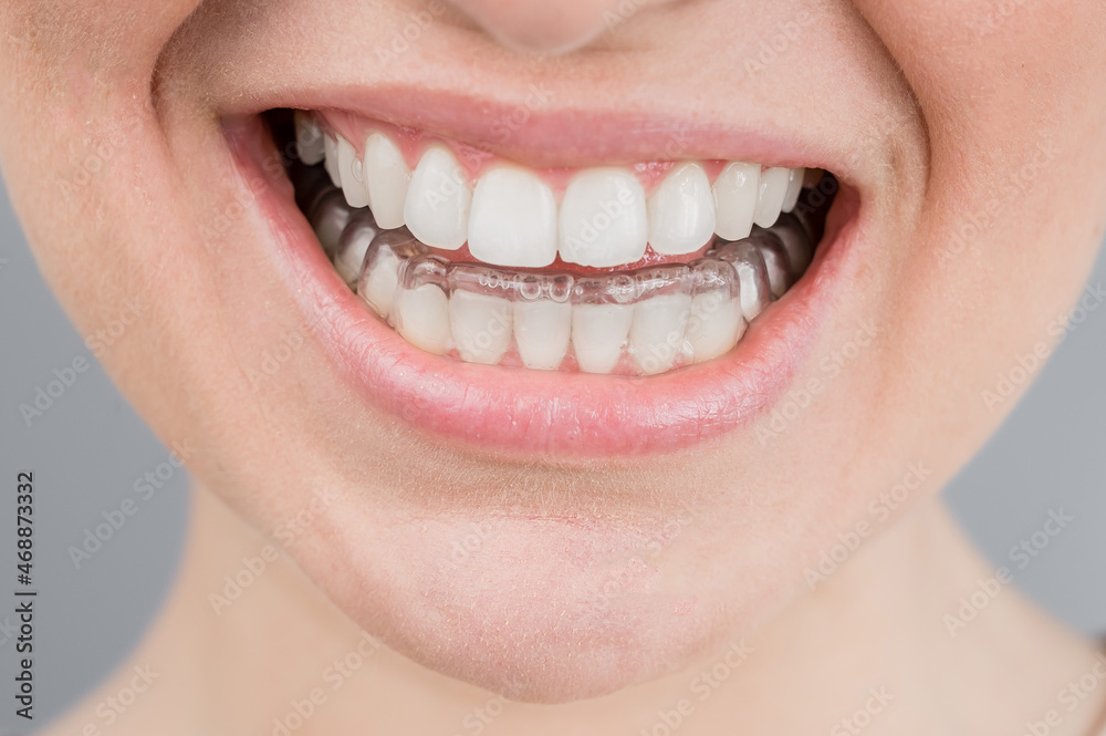 Fototapeta premium Close-up portrait of a woman putting on a transparent plastic retainer. A girl corrects a bite with the help of an orthodontic device
