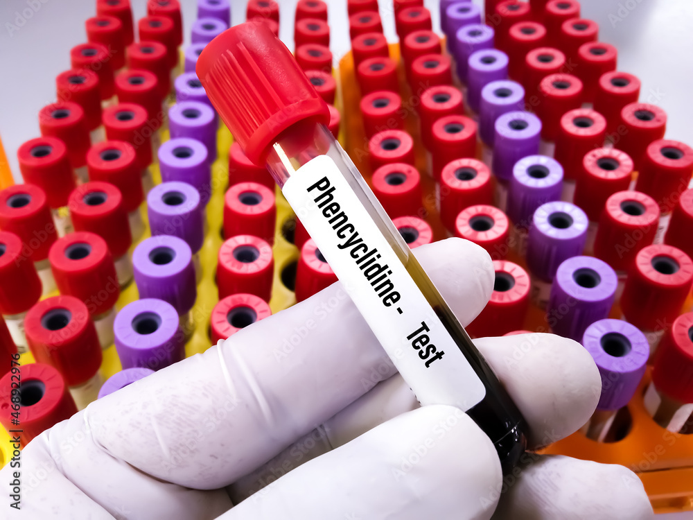 Laboratory sample of blood for doping drugs LSD, test. Doping is the