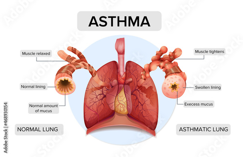 Asthma. Lung structure