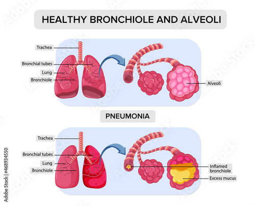 Healthy bronchiole and alveoli