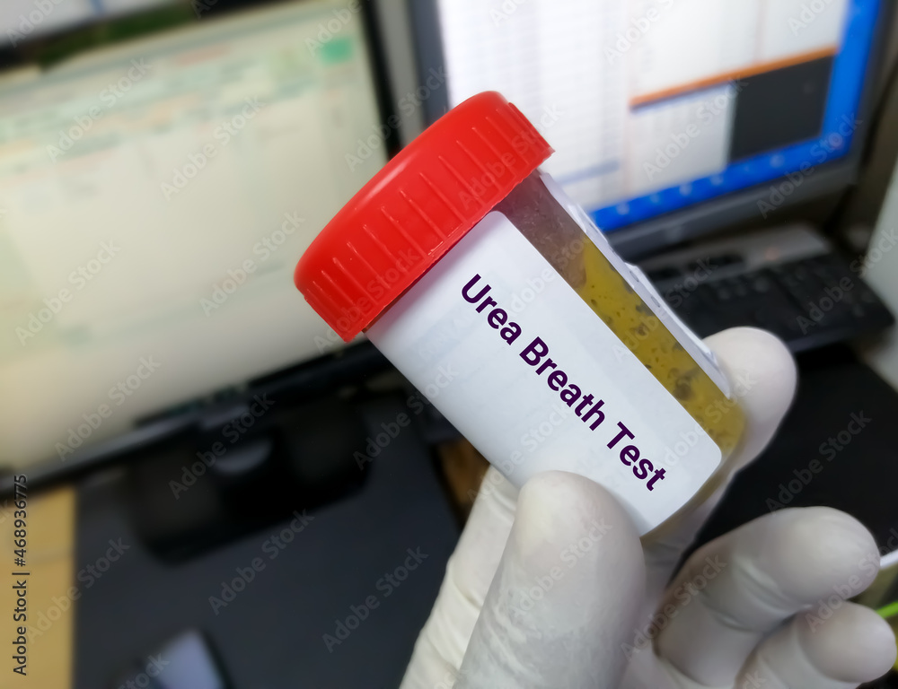 Technician hold container with stool sample for Urea breath test