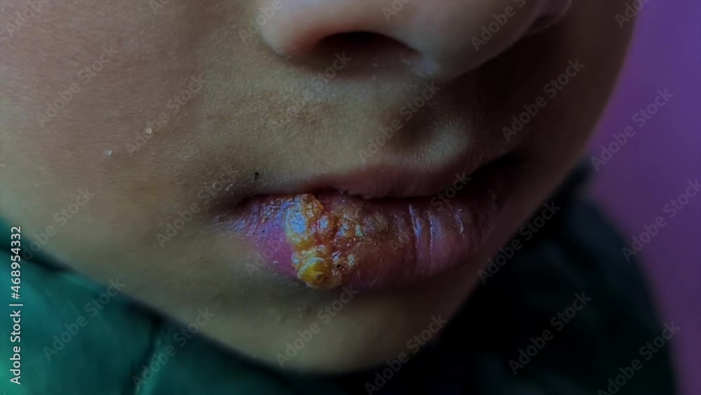 Herpes simplex Infection on boy lip fungus medically called oral
