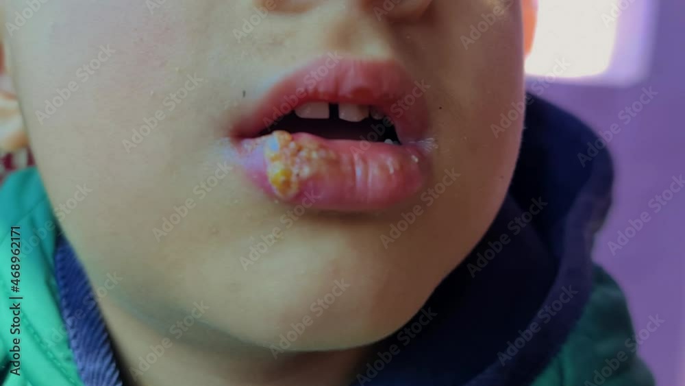 Herpes simplex Infection on boy lip fungus medically called oral