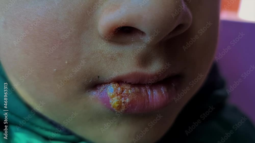 Video „Herpes simplex Infection on boy lip fungus medically called oral ...