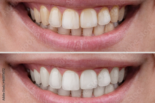 Close-up of a woman's smile before and after teeth whitening.
