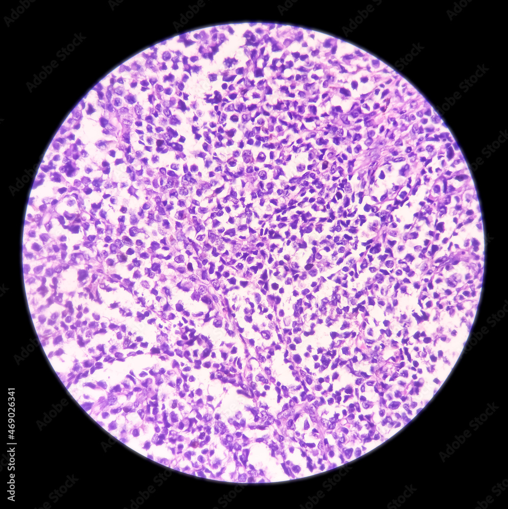 Microscopic image of malignant melanoma in pigmented ulcer. show malignant neoplasm, atypical melanocytes cells, vesicular nuclei, melanin pigmentation, selective focus